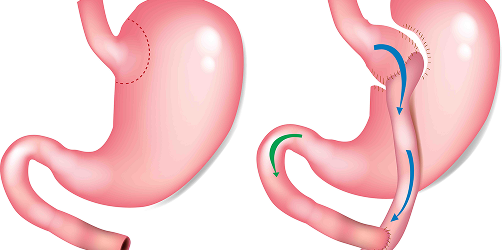 Ilustración de bypass gástrico